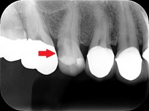 レントゲンで虫歯を☑