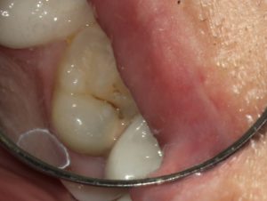 定期健診で発見した虫歯