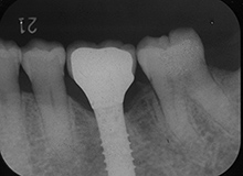 臼歯部のインプラント