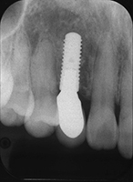 前歯部のGBR、CTG併用インプラント