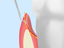 歯周ポケット掻破（そうは）術