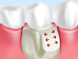 歯周組織再生療法1 GTR法