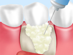 歯周組織再生療法2 エムドゲイン法